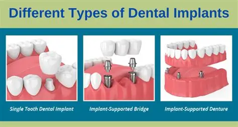 Dental Implants